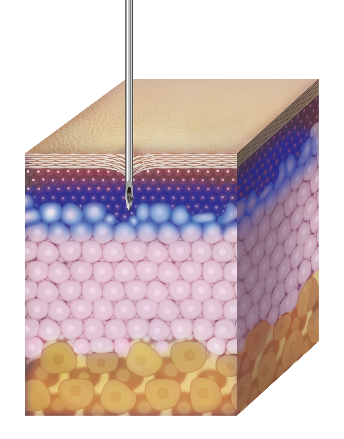 Turtlepin 1mm application depth